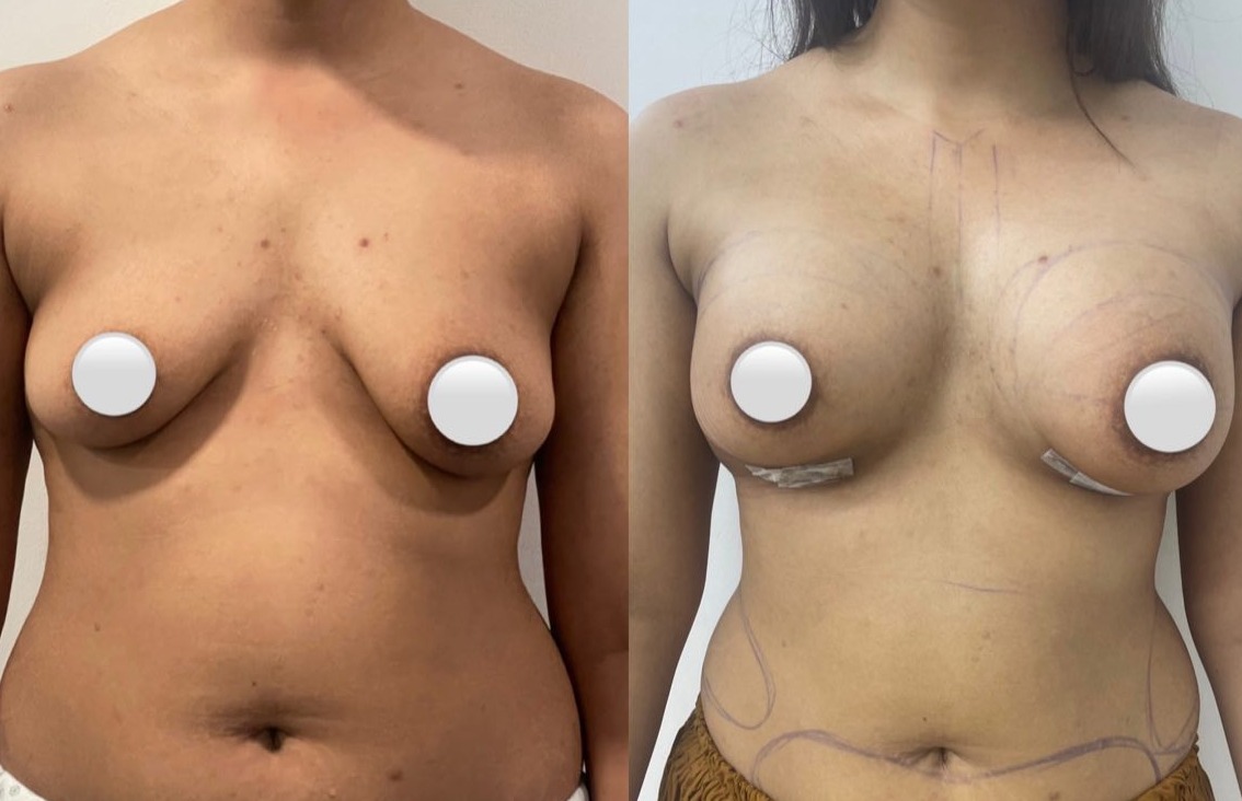 Breast Implants
