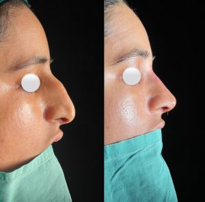 Rinoplasty