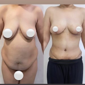Mommy Makeover