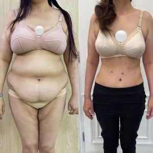 Mommy Makeover