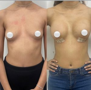 Breast Implants
