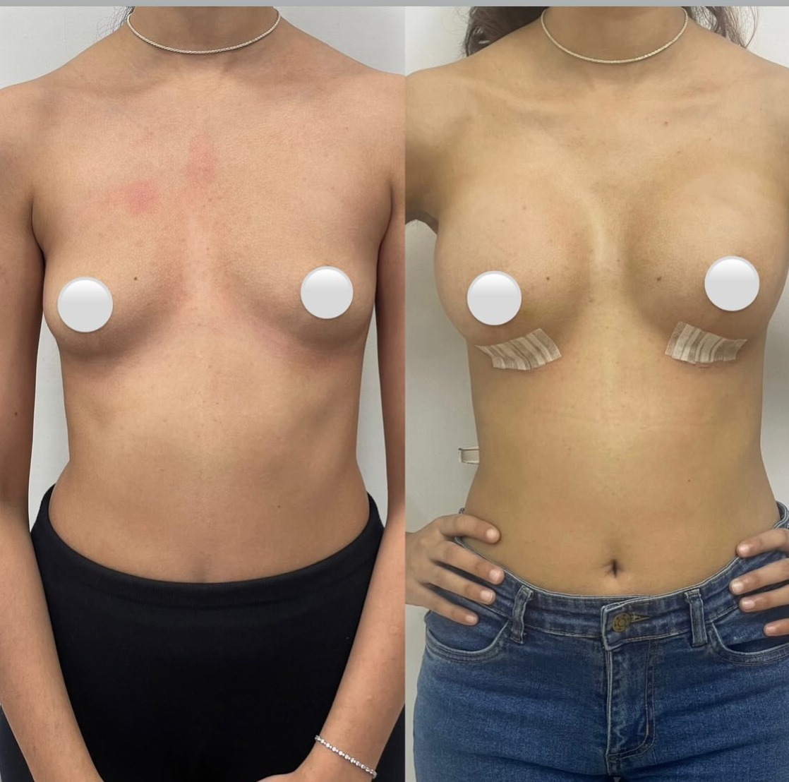 Breast Implants
