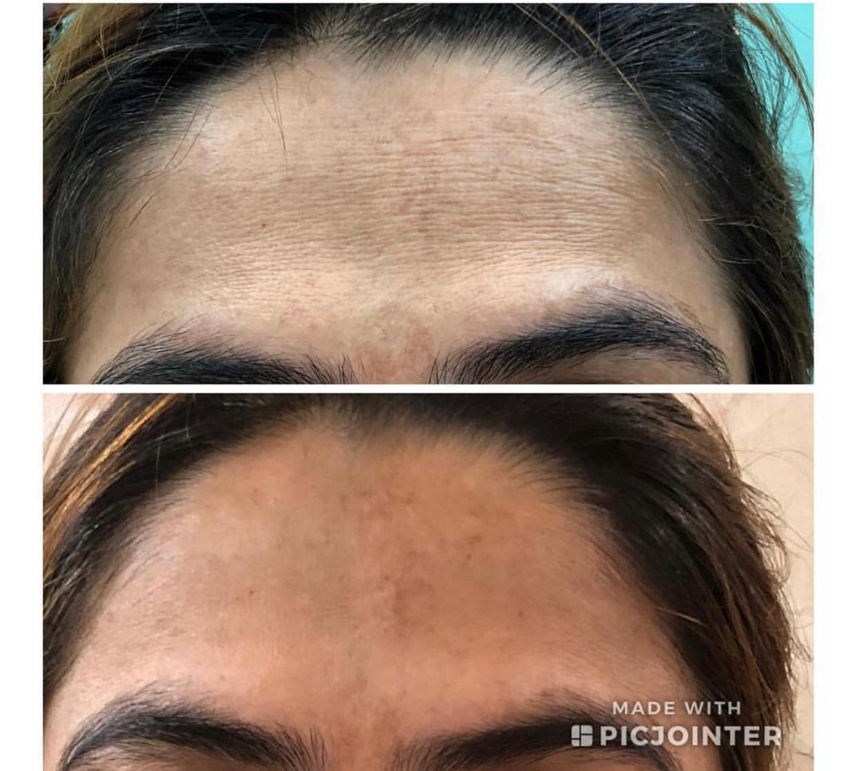 Botox