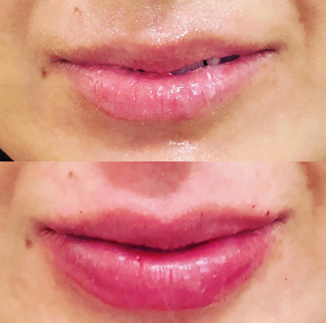 Fillers
