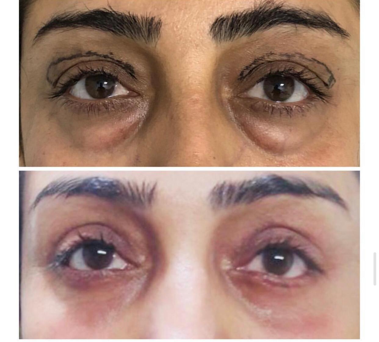 Upper And Lower Eye Lid Surgery