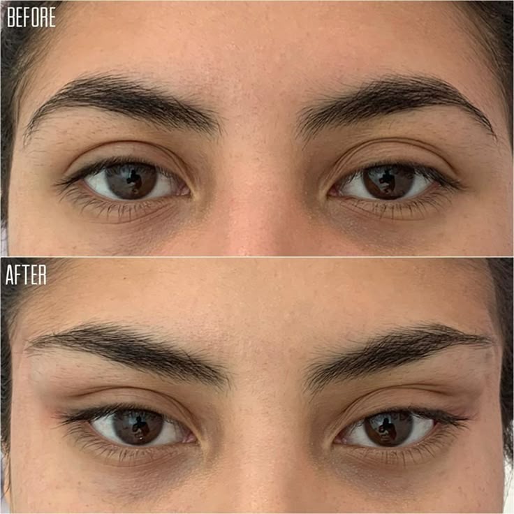 BROW LIFT