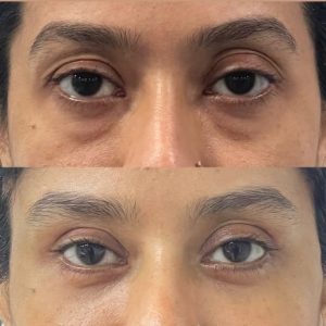 Eye FILLER