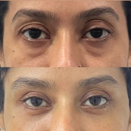 Eye FILLER