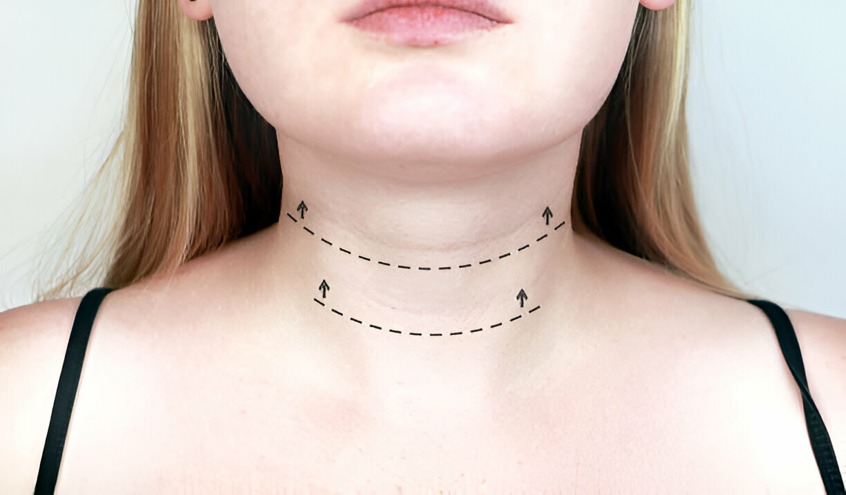 necklift
