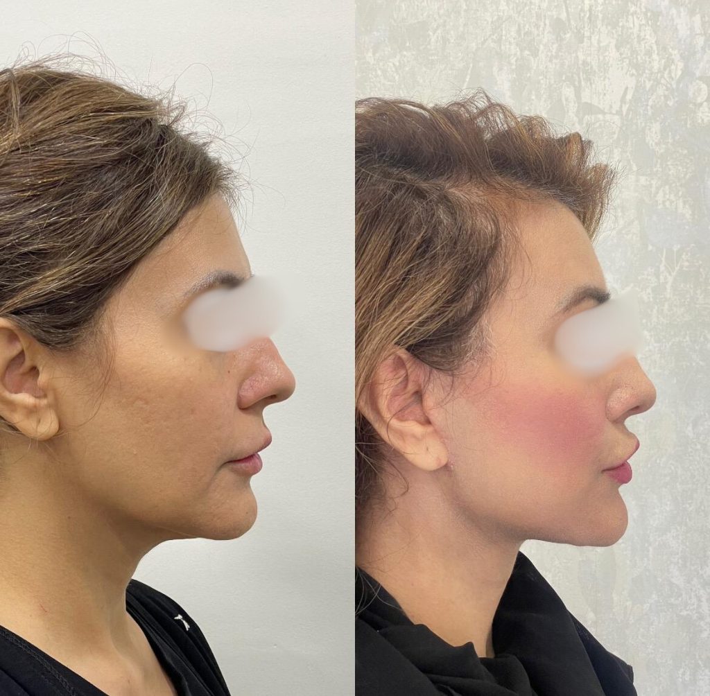 facelift