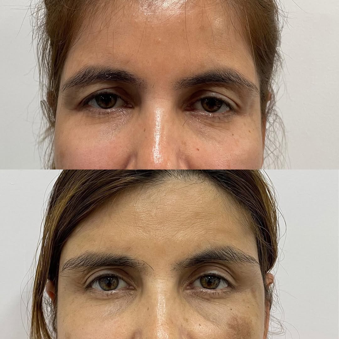 BROW LIFT