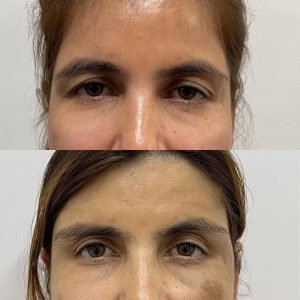 Beloplasty