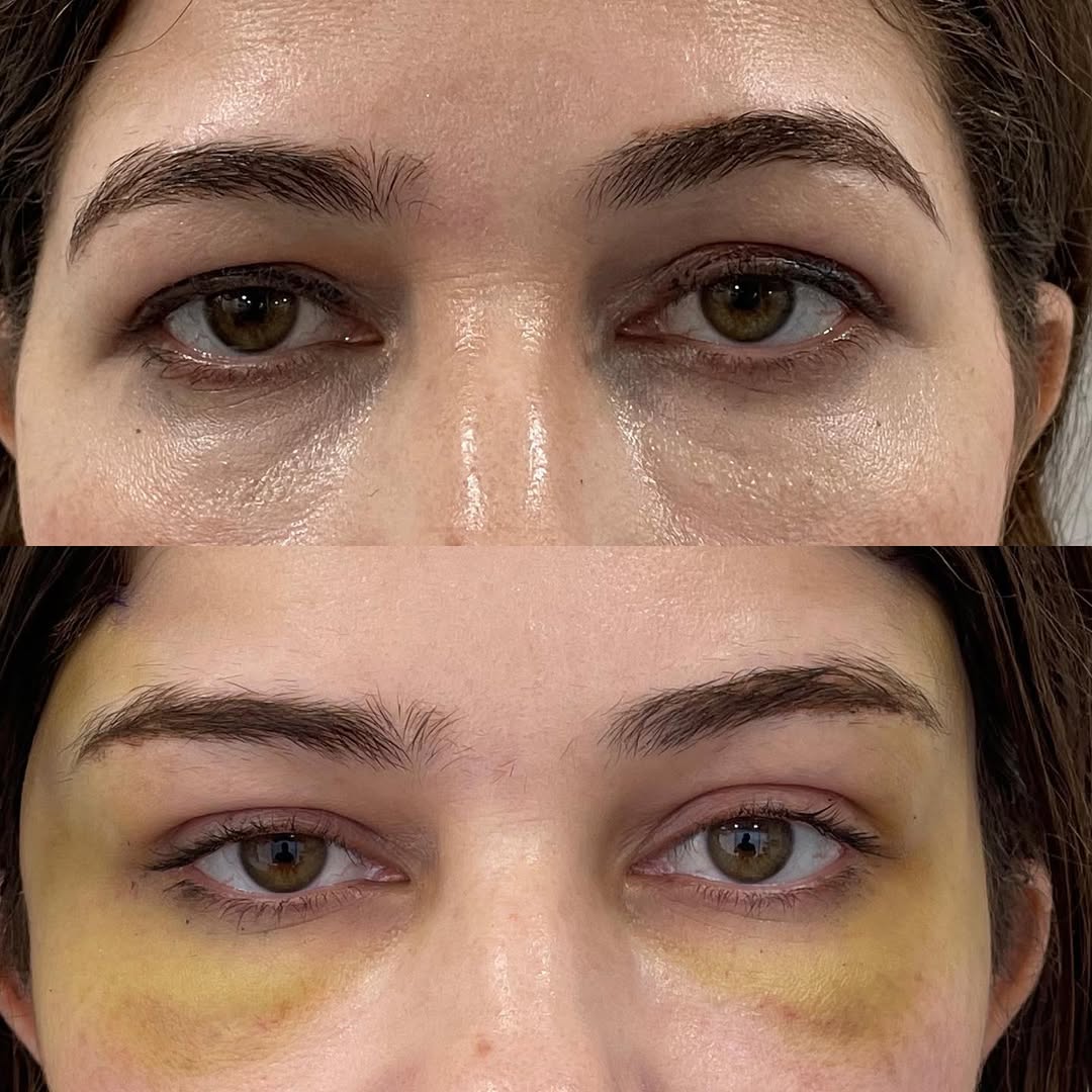 Beloplasty