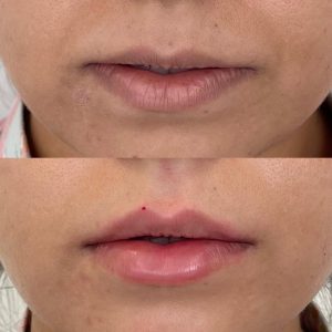 Lip Filler