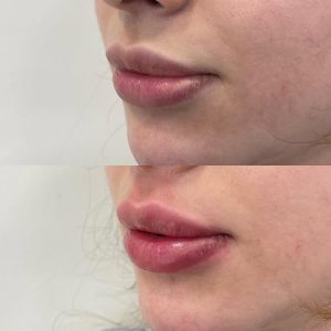 Lip Filler
