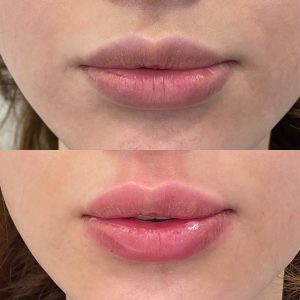 Lip Filler