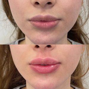 Lip Filler