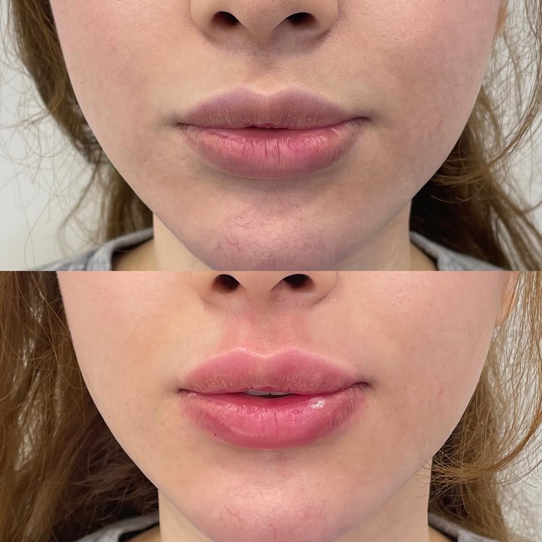 Lip Filler