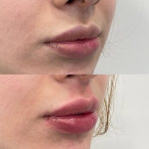 Lip Filler