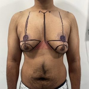 gyne