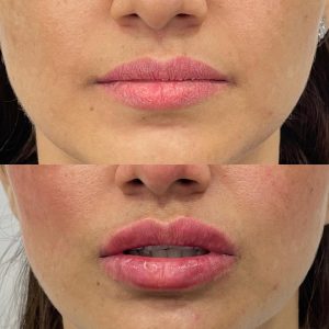 Lip Filler