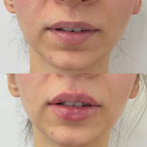 Lip Filler