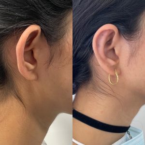 Otoplasty