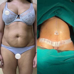 Body Conturing