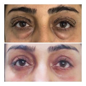 EyeFiller