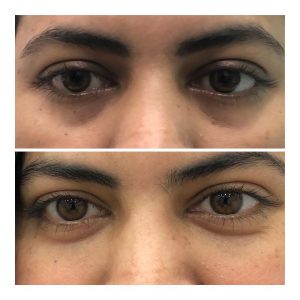 EyeFiller
