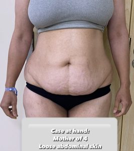 Tummy tuck