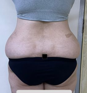 Tummy tuck