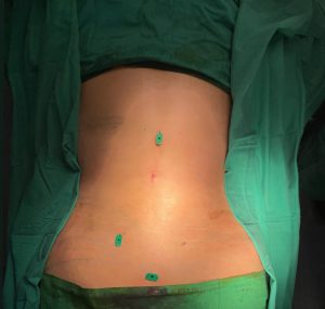 Tummy tuck