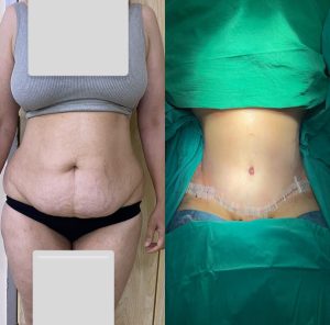 Tummy tuck