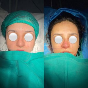Rinoplasty