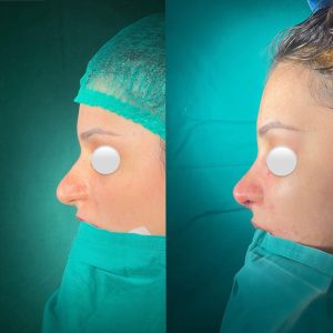 Rinoplasty