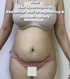 tummy tuck