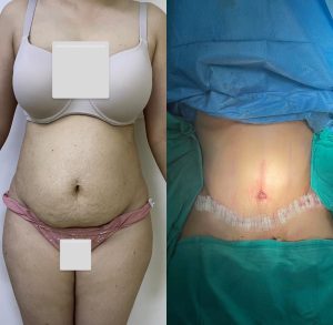 tummy tuck