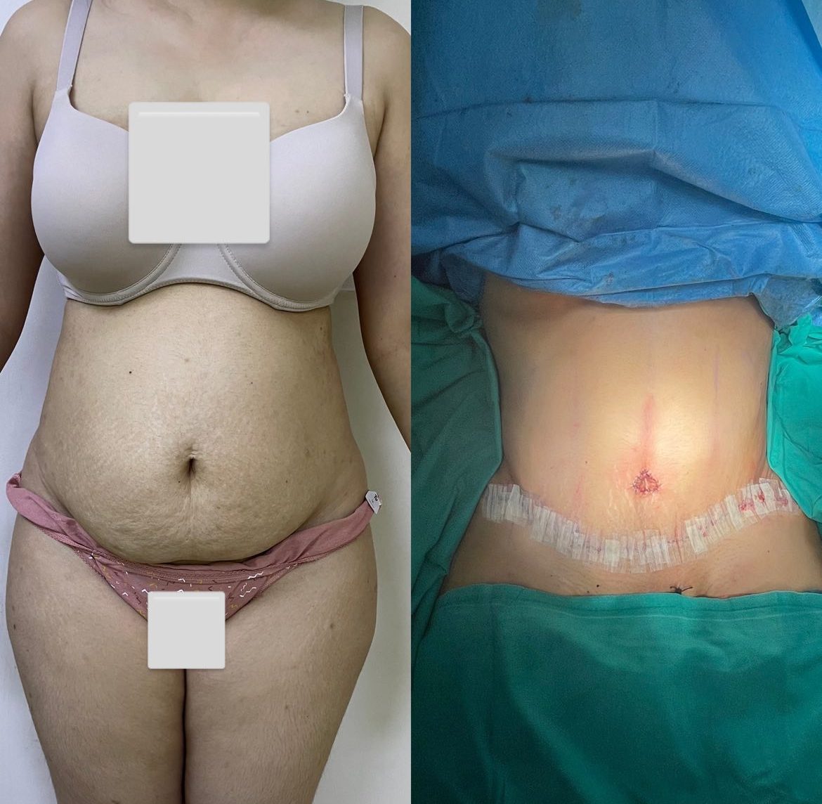 tummy tuck