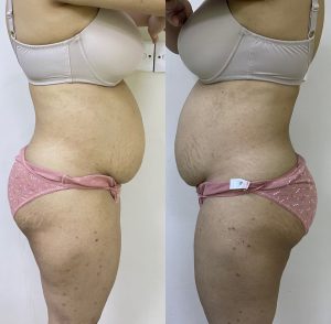 tummy tuck
