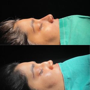 Rinoplasty