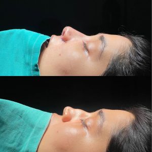 Rinoplasty