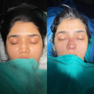 Rinoplasty