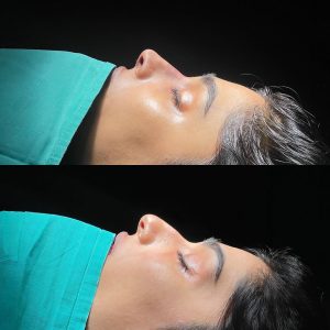 Rinoplasty
