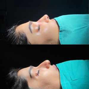 Rinoplasty