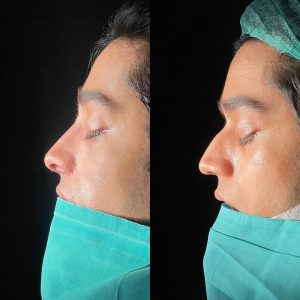Rinoplasty