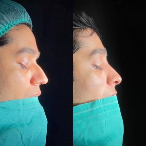 Rinoplasty