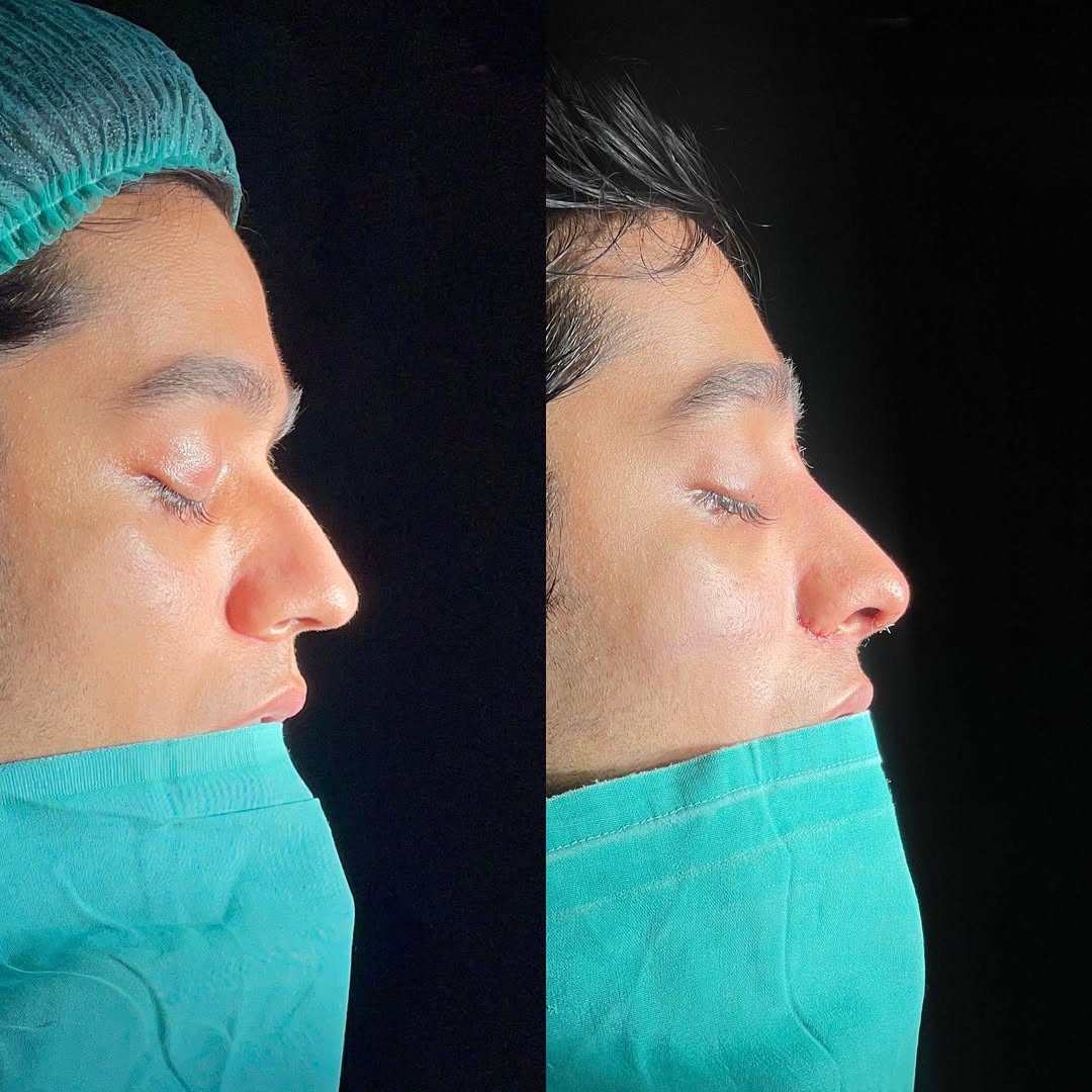Rinoplasty