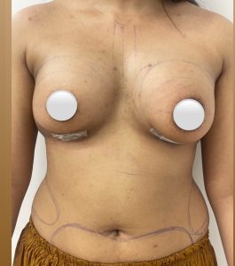 Breast