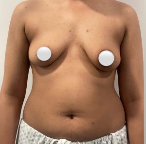 Breast